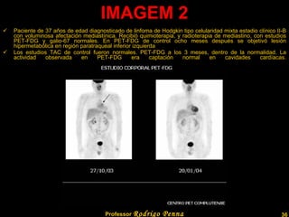 IMAGEM 2 Paciente de 37 años de edad diagnosticado de linfoma de Hodgkin tipo celularidad mixta estadio clínico II-B con voluminosa afectación mediastínica. Recibió quimioterapia, y radioterapia de mediastino, con estudios PET-FDG y galio-67 normales. En PET-FDG de control ocho meses después se objetivó lesión hipermetabólica en región paratraqueal inferior izquierda  Los estudios TAC de control fueron normales. PET-FDG a los 3 meses, dentro de la normalidad. La actividad observada en PET-FDG era captación normal en cavidades cardíacas. Professor  Rodrigo Penna 