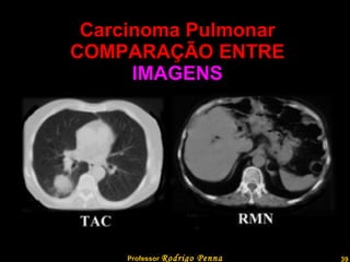 Carcinoma Pulmonar COMPARAÇÃO ENTRE  IMAGENS Professor  Rodrigo Penna  www.fisicanovestibular.com.br   