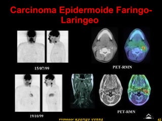 Carcinoma Epidermoide Faringo-Laringeo  Professor  Rodrigo Penna 