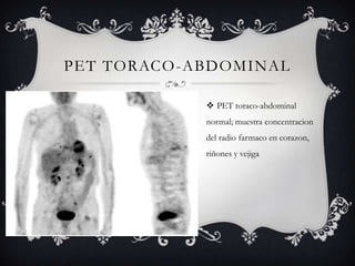 PET TORACO -ABDOMINAL

              PET toraco-abdominal
             normal; muestra concentracion
             del radio farmaco en corazon,
             riñones y vejiga
 