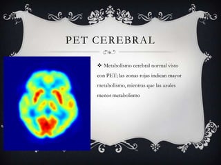 PET CEREBRAL

     Metabolismo cerebral normal visto
    con PET; las zonas rojas indican mayor
    metabolismo, mientras que las azules
    menor metabolismo
 