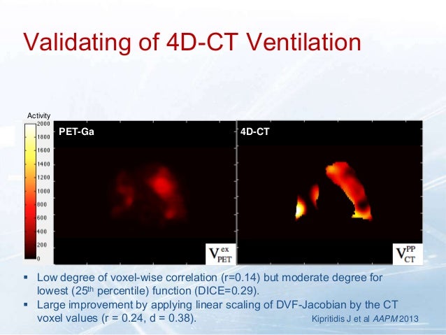 Advantages Of Ga 68 4d Pet Ct Ventilation Perfusion V Q Imaging