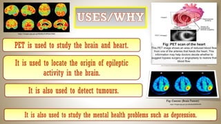 https://images.app.goo.gl/cxRorBnziNANT6vW6
Fig: Cancer (Brain Tumor)
It is also used to detect tumours.
It is also used to study the mental health problems such as depression.
It is used to locate the origin of epileptic
activity in the brain.
https://images.app.goo.gl/MsA8acVuW3nk1C8s6
PET is used to study the brain and heart. Fig: PET scan of the heart
This PET image shows an area of reduced blood flow
from one of the arteries that feeds the heart. This
information may help doctors decide whether to
suggest bypass surgery or angioplasty to restore that
blood flow.
https://www.mayoclinic.org/-/media/kcms/gbs/patient-consumer/images/2013/08/26/10/03/my00238_im03976_mcdc_pet_heartthu_jpg.jpg
 