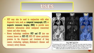 • PET may also be used in conjunction with other
diagnostic tests, such as computed tomography (CT) or
magnetic resonance imaging (MRI) to provide more
definitive information about malignant (cancerous)
tumors and other lesions.
• Newer technology combines PET and CT into one
scanner, known as PET/CT. PET/CT shows particular
promise in the diagnosis and treatment of lung
cancer, evaluating epilepsy, Alzheimer's disease and
coronary artery disease.
Fig: PET plus CT
Combining a PET scan with an MRI or CT scan can help make the images
easier to interpret. At left is a CT scan, while the center image is a PET scan.
The image on the right is a combined PET-CT scan. The bright spot in the
chest, seen best on the PET and PET-CT scans is lung cancer.
 