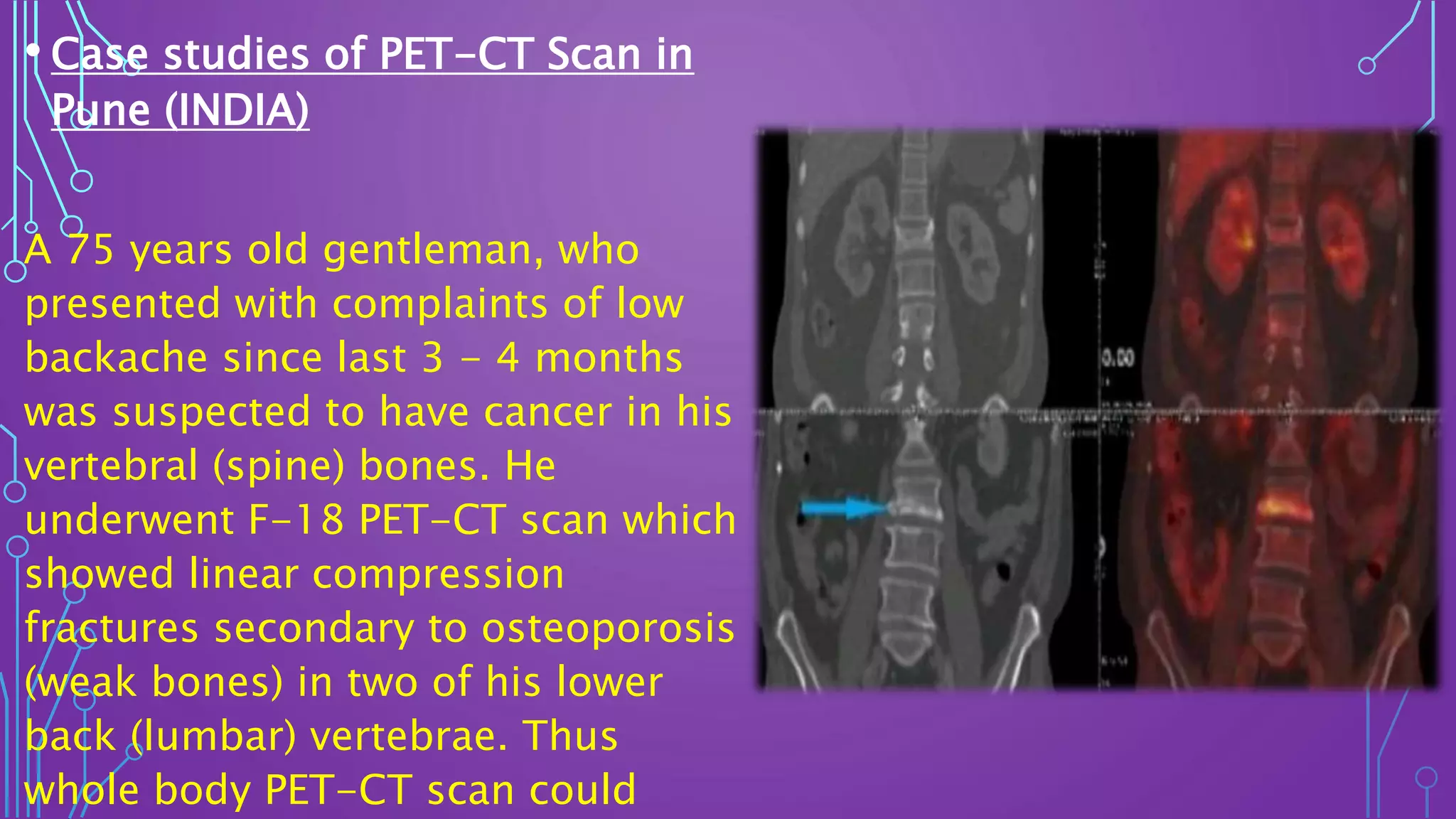 PET-CT | PPTX