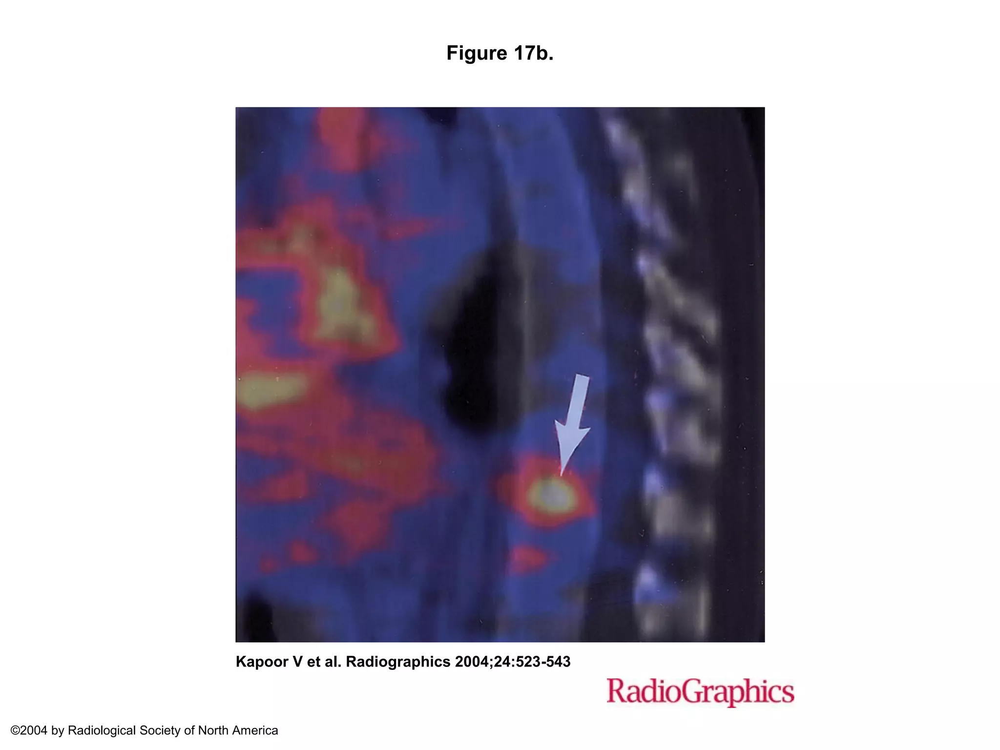 PET-CT Scan(Principles and Basics) | PDF