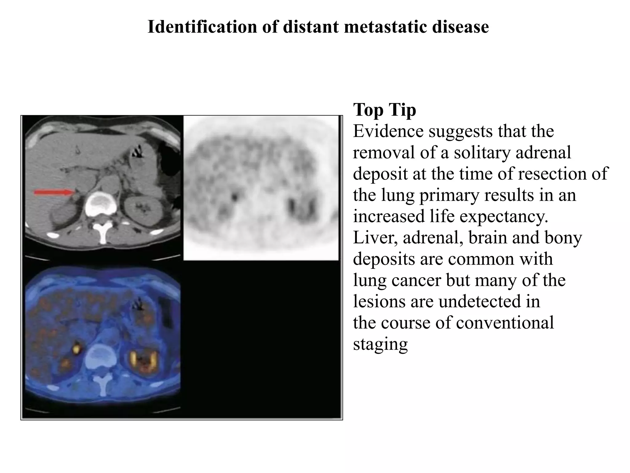 PET-CT Scan(Principles and Basics) | PDF