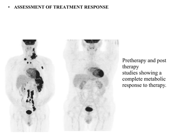 PET-CT Scan(Principles and Basics) | PDF | Lung and Respiratory Health ...
