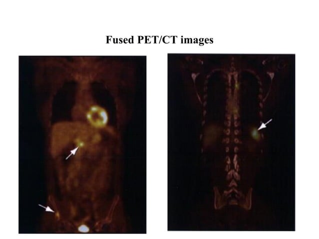 PET-CT Scan(Principles and Basics) | PDF | Lung and Respiratory Health ...