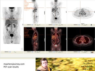 maartensjourney.com  PET scan results  