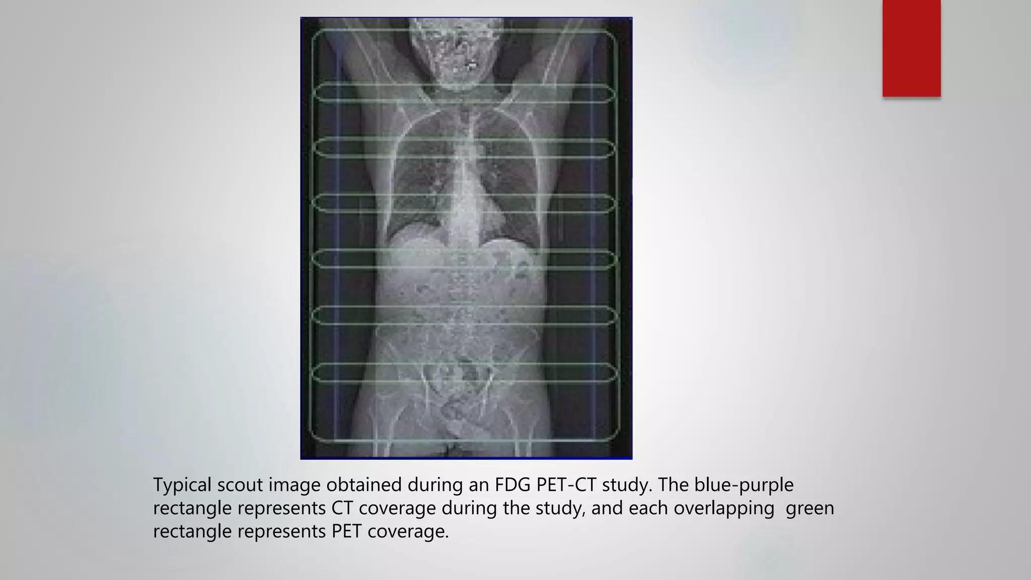 Typical scout image obtained during an FDG PET-CT study. The blue-purple
rectangle represents CT coverage during the study, and each overlapping green
rectangle represents PET coverage.
 
