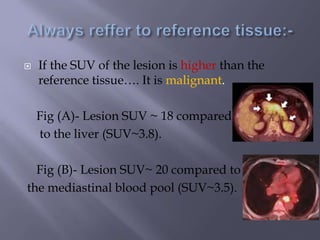  If the SUV of the lesion is higher than the
reference tissue…. It is malignant.
Fig (A)- Lesion SUV ~ 18 compared
to the liver (SUV~3.8).
Fig (B)- Lesion SUV~ 20 compared to
the mediastinal blood pool (SUV~3.5).
 