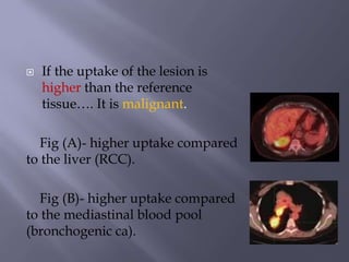  If the uptake of the lesion is
higher than the reference
tissue…. It is malignant.
Fig (A)- higher uptake compared
to the liver (RCC).
Fig (B)- higher uptake compared
to the mediastinal blood pool
(bronchogenic ca).
 