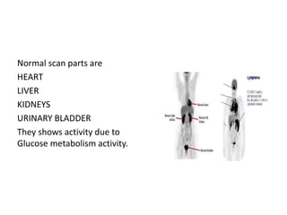 Normal scan parts are
HEART
LIVER
KIDNEYS
URINARY BLADDER
They shows activity due to
Glucose metabolism activity.
 