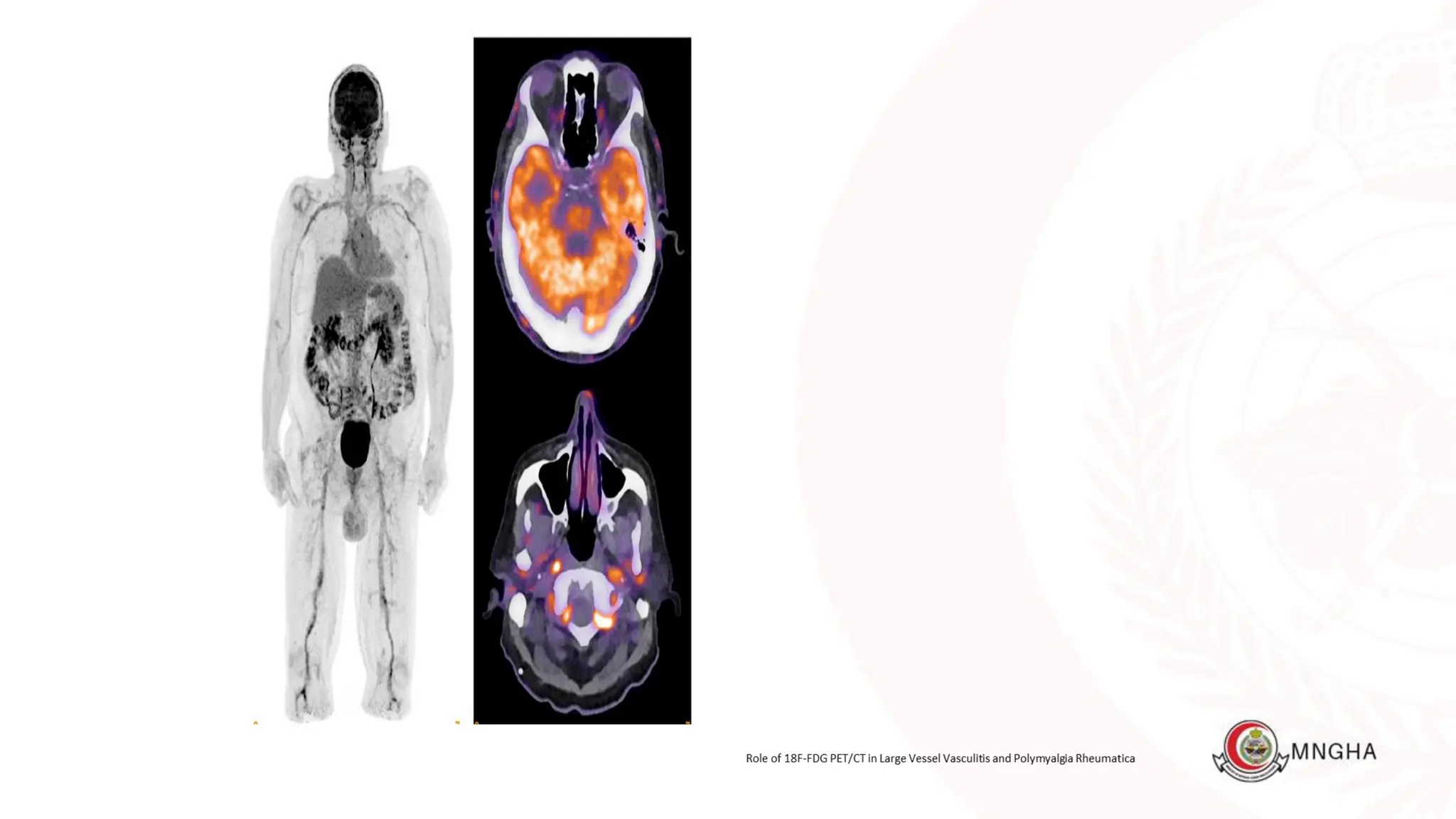 PET CT Beginners Guide part IV Covering Vasculitis and IE | PDF