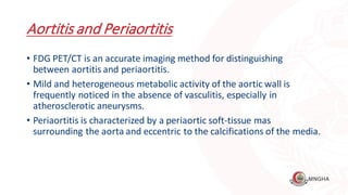 PET CT Beginners Guide part IV Covering Vasculitis and IE | PDF