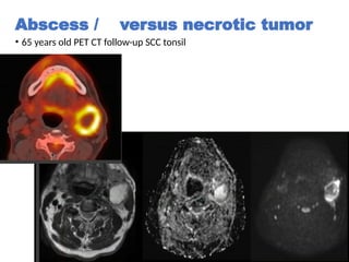 PET_CT Head and neck carcinoma and MRI.pptx