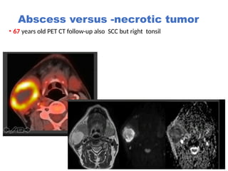 PET_CT Head and neck carcinoma and MRI.pptx