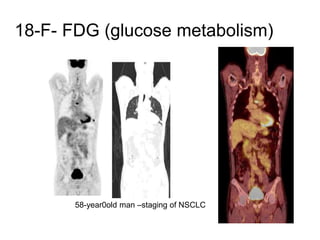 18-F- FDG (glucose metabolism)
58-year0old man –staging of NSCLC
 