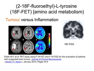 (2-18F-fluoroethyl)-L-tyrosine
(18F-FET) [amino acid metabolism)
Tumour versus Inflammation
Eddie W.F. et al PET study using F-18 FET and F-18 FDG for the evaluation of patients
with suspected brain tumour. Journal of Clinical Neuroscience
.volume 17, Issue 1, January 2010, Pages 43-4
18F-FDG
 