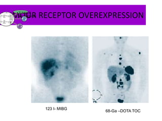 TUMOUR RECEPTOR OVEREXPRESSION•TUMOUR
METABOLISM
123 I- MIBG
68-Ga –DOTA TOC
 