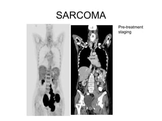 SARCOMA
Pre-treatment
staging
 