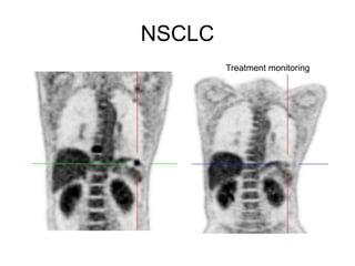 NSCLC
Treatment monitoring
 