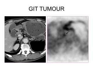 GIT TUMOUR
 