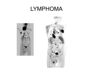 LYMPHOMA
 