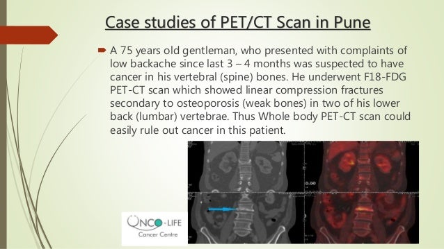 Pet CT Scan for Cancer Diagnosis - Onco Life Cancer Centre