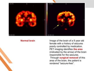Normal brain Image of the brain of a 9 year old
female with a history of seizures
poorly controlled by medication.
PET imaging identifies the area
(indicated by the arrow) of the brain
responsible for the seizures.
Through surgical removal of this
area of the brain, the patient is
rendered "seizure-free".
Htt://www.nucmed.buffalo.edu/petdef.htm
6/5/2020
 
