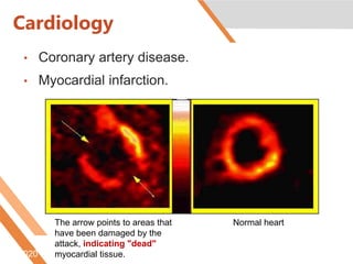 Cardiology
• Coronary artery disease.
• Myocardial infarction.
6/5/2020 http://www.radiologyinfo.org/content/petomography.htm
The arrow points to areas that
have been damaged by the
attack, indicating "dead"
myocardial tissue.
Normal heart
 