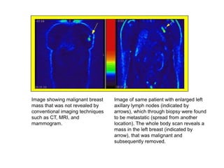 Image showing malignant breast
mass that was not revealed by
conventional imaging techniques
such as CT, MRI, and
mammogram.
Image of same patient with enlarged left
axillary lymph nodes (indicated by
arrows), which through biopsy were found
to be metastatic (spread from another
location). The whole body scan reveals a
mass in the left breast (indicated by
arrow), that was malignant and
subsequently removed.
Htt://www.nucmed.buffalo.edu/petdef.htm
6/5/2020
 