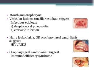• Mouth and oropharynx
• Vesicular lesions, tonsillar exudate: suggest
Infectious etiology:
1) streptococcal pharyngitis
2) coxsakie infection
• Hairy leukoplakia. OR oropharyngeal candidiasis
suggest:
HIV /AIDS
• Oropharyngeal candidiasis.. suggest
Immunodefficiency syndrome
 