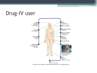 Drug-IV user
 
