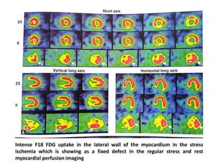 Intense F18 FDG uptake in the lateral wall of the myocardium in the stress
ischemia which is showing as a fixed defect in the regular stress and rest
myocardial perfusion imaging
 