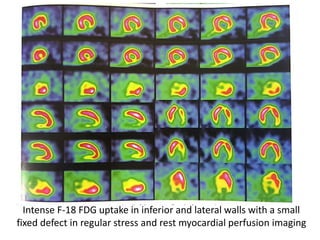 Intense F-18 FDG uptake in inferior and lateral walls with a small
fixed defect in regular stress and rest myocardial perfusion imaging
 