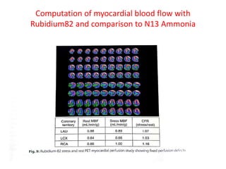 Computation of myocardial blood flow with
Rubidium82 and comparison to N13 Ammonia
 