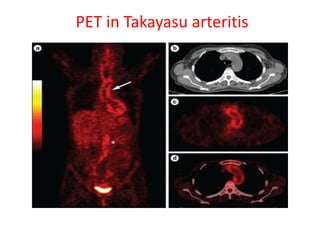PET in Takayasu arteritis
 