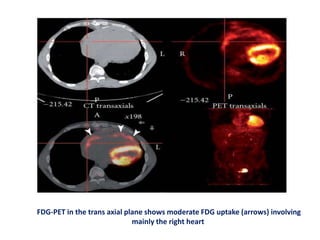 FDG-PET in the trans axial plane shows moderate FDG uptake (arrows) involving
mainly the right heart
 