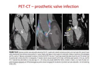 PET-CT – prosthetic valve infection
 
