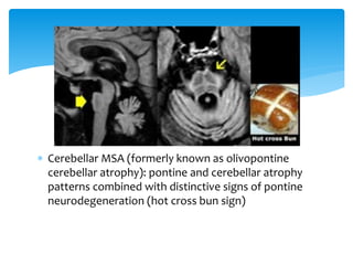 PET/MR imaging in neurodegenerative diseases | PPTX