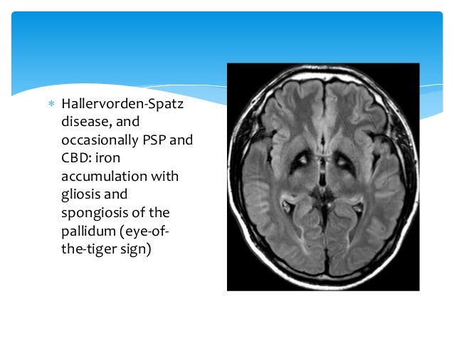 PET/MR imaging in neurodegenerative diseases