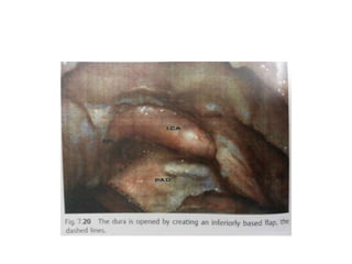 Transcochlear transpetrous approach
 