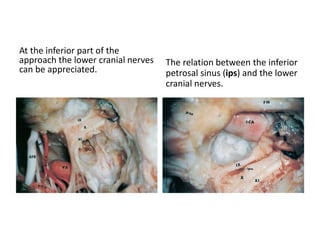 With more traction of the tentorium, a panoramic view of the
structures in the angle is available. The trochlear nerve (IV) is
seen before piercing the tentorium to gain access to the middle
fossa.
 