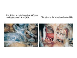 Transcochlear Transpetrous ( =
Transapical )
 