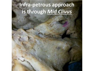An extended mastoidectomy,
labyrinthectomy, identification
of the internal auditory canal, and
drilling of the cochlea has been
performed.
The facial nerve (FN) has been
skeletonized.
The facial nerve (FN) has been skeletonized.
 