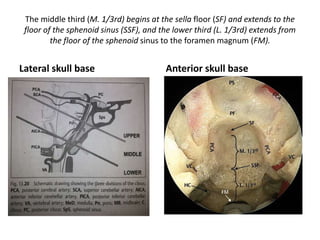 Identification of the greater
superficial petrosal nerve (gspn).
The greater superficial petrosal
nerve is (gspn) cut.
 