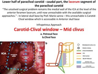 The geniculate ganglion (GG) and
the labyrinthine portion of
the facial nerve (FN) are elevated.
The tympanic segment is freed.
 