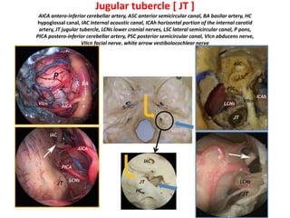 The whole contents of the internal
auditory canal are transposed
posteriorly with the facial nerve (FN).
New position of the facial nerve
(FN) after posterior rerouting
 